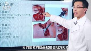 05 鼻竇炎的治療與保健方法