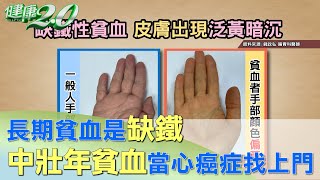 長期貧血是缺鐵害的？ 中壯年貧血當心癌症找上門 健康2.0