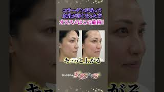 コラーゲン減少し皮膚が薄くなる…ダウンタイムなしで叶う治療法は？？ #たるみ治療 #サーマジェン #コラーゲン
