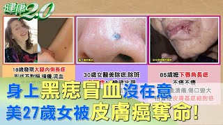 身上黑痣冒血沒在意 美27歲女被皮膚癌奪命！ 健康2.0