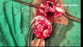 Myomectomy at NDVH
