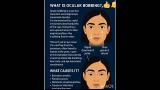 "Ocular Bobbing"#eyecare #optometry #visioncare #optometrist #healthyeyes #eyes #healthcare #medical