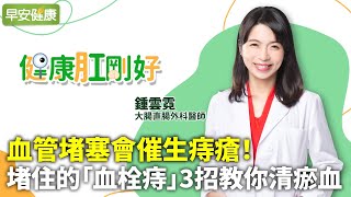 血管堵塞會催生痔瘡！堵住的「血栓痔」3招教你清瘀血︱鍾雲霓 大腸直腸外科醫師【早安健康】