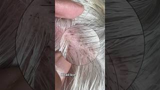Head lice on hair l lice removal service
