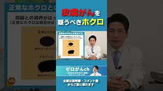 皮膚がんを疑うべきホクロ　#shorts