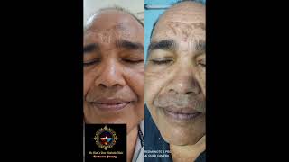 Review from patient  (testimonial -35)#skincaretreatment