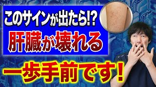 【危険】肝硬変目前の人に現れる症状と改善法について再生医療医が徹底解説します！