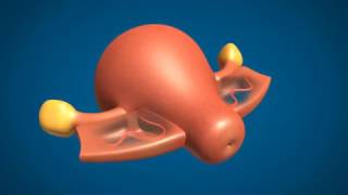 Dr. Panicker's Non Descent Vaginal Hysterectomy - Animation