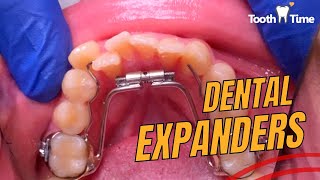 How to turn a dental expander - Full video - Braces On - Toothtime  New Braunfels #dentist