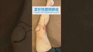 【変形性膝関節】膝内側の痛みと原因を1分で解説　 #八尾 #膝痛 #大阪　#shorts