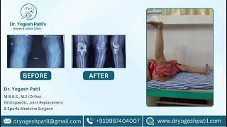 Before & After Knee Surgery