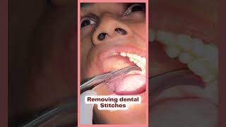 Removing Dental Stitches || Painless Dental Treatment || #shorts