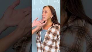 She Got a Facelift at 61 — See Her Recovery 7 Days Later #Facelift