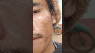 #skincare #pimplelife #songlyrics #skincareroutine #pimplecare #115 #music #antipimple #vlog #song