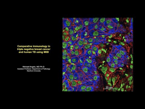 Comparative immunology in triple negative breast cancer and human TB using MIBI