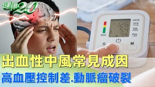 出血性中風常見成因 高血壓控制差.動脈瘤破裂 健康2.0 @tvbshealth20