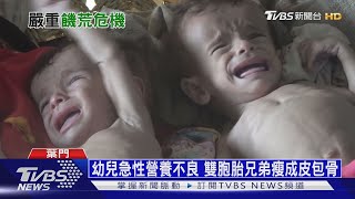 【十點不一樣】葉門內戰引發最慘饑荒 58萬幼兒營養不良