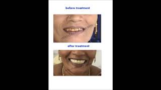 Best Dental Laser Teeth Whitening Treatment in chennai | Best Dental clinic in india