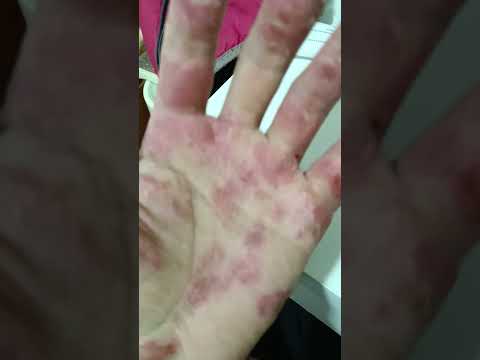 severe rotten hand