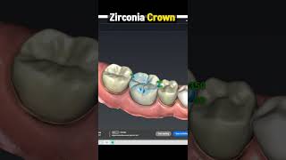 Zirconia Crown Procedure Explained : Pros and Cons in 1 minute
