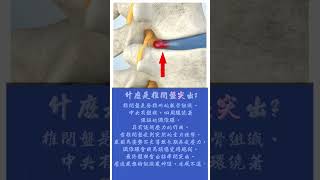 【健康小常識】什麼是椎間盤突出#shorts#醫學小常識#椎間盤突出#脊椎