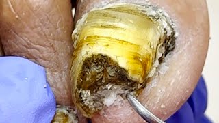 Amazing Toenails Thickness! Remove Bad Nails Step By Step!【Xue Yidao】