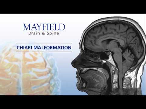 Mayfield Minute: Chiari Malformation