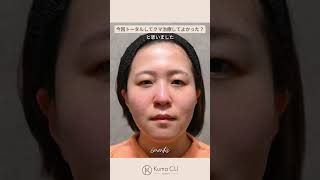 Interview video🎥#Dark circles removal #Dark circles treatment #Cosmetic surgery