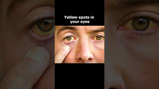 What Your Eye Symptoms May Mean  - Yellow