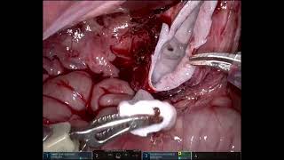 Rt Robotic Pyeloplasty In a 3 month old child