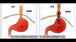 【一分鐘的健康】 暴飲暴食對消化系統有那些傷害