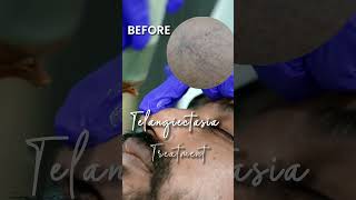 Worried ☹️About Telangiectasias? || Dr. Priyanka Reddy || DNA Skin Clinic || #shorts #skincaretips