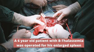 Splenectomy of a B-Thalassemia major patient with huge Splenomegaly