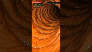 Constipation in the Colon | Human Anatomy 3D Animation | Stomach AI Generated Art