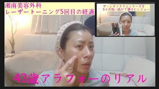 【アラフォー】湘南美容外科でレーザートーニング5回目の経過&ザ・レチノタイムシリーズを5ヶ月使い続けて勝手にレビュー。MIX動画