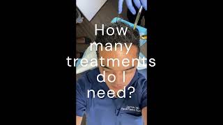 A #prp #hairrestoration session for myself!