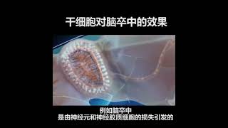 #干细胞对脑卒中的效果