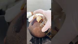 head wash after hair transplant 10 days | head wash after hair transplant