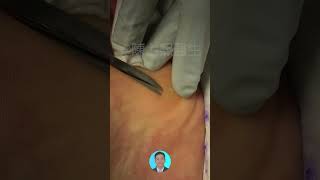 足底疣手術切除 plantar wart removed by surgery