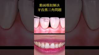 #牙齒矯正 #熱門 黑三角是指牙齦退縮後，牙齒靠近牙齦位置出現的黑色三角形間隙。 一般修復有多種方法，較為便捷的為視頻中的樹脂修復法。