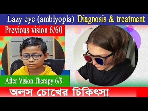 Amblyopia (lazy eye) Treatment। 6/60 previous  vision 6/9 after vision Therapy  without patching।