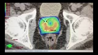 5-Session Radiation Treatment For Prostate Cancer (SBRT or Stereotactic Body Radiation Therapy)