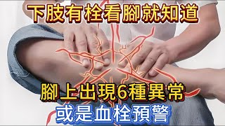 下肢有栓看腳就知道，腳上出現6種異常，或血栓「預警」！