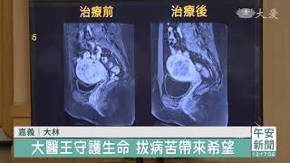 合併免疫療法 死亡邊緣搶救癌患生命
