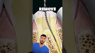 Root Canal Explained !?