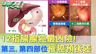 12指腸腺癌最凶險！ 第三.第四部位罹癌預後差 健康2.0
