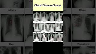 Chest Disease in x-ray # Lungs disease # Defferent chest x-ray #radiography #lungproblems