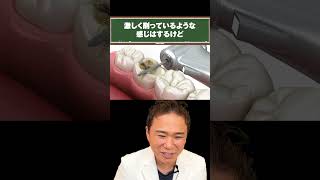 虫歯の削り方がヤバイ