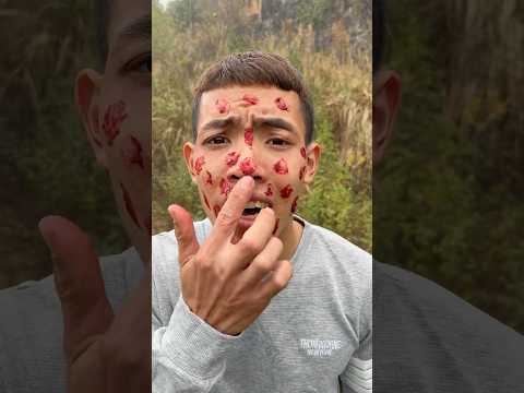 Survival Tips: Simple Acne Treatment in the Wilderness