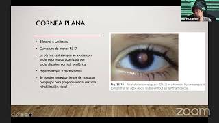 Anterior segment developmental anomalies including aniridia